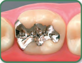 メタルインレーを装着した状態