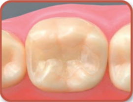 セラミックインレーを装着した状態