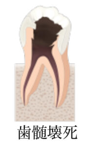 ①根尖性歯周炎の予防