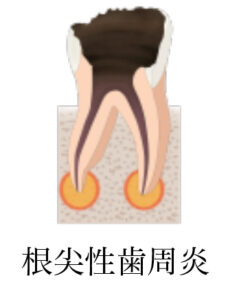 ②根尖性歯周炎の治療