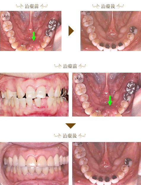 歯周病症例3
